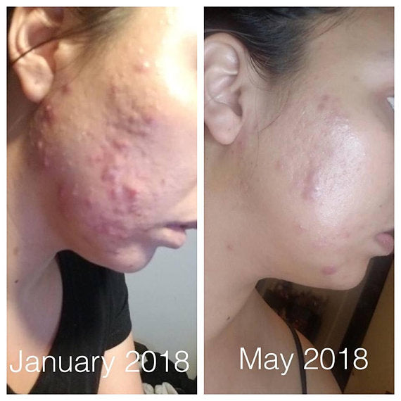 Super Acne Fighter | Organic Acne Treatment Serum for Blemishes & Scar Care