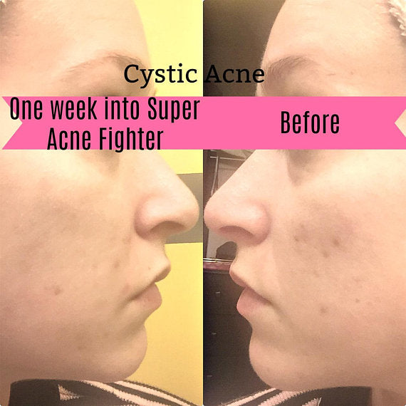 Super Acne Fighter | Organic Acne Treatment Serum for Blemishes & Scar Care